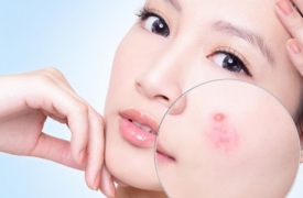 Lý do khiến da bạn bị nhờn